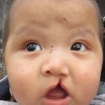 1583px cleftlipandpalate.jpg