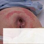 20070601135249pressure ulcer.jpg