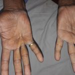 2560px dupuytrens contracture.jpg