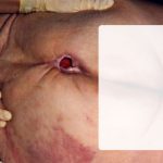 640px dekubitus back.jpg