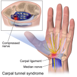 carpal tunnel syndrome.png