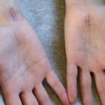 carpal tunnel scars.jpg