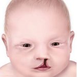 cleft lip full.jpg