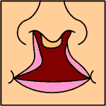 cleftlip3.png
