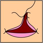 cleftlip2.jpg