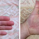 hand post dupuytren op with stiches and healed.jpg