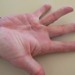 morbus dupuytren fcm.jpg