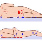 pressure ulcer points.jpg
