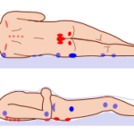 pressure ulcer points.svg.png