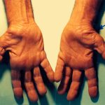 untreated carpal tunnel syndrome scaled 1.jpg