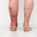 close up photo legs with lymphostasis from.jpg