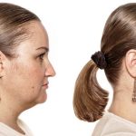 double chin before after facelift.jpg