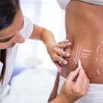 surgeon drawing lines womans abdomen liposuction cellulite removal 4.jpg