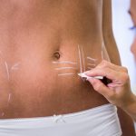 surgeon drawing lines womans abdomen liposuction cellulite removal scaled 1.jpg