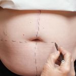 surgeon draws correction marks belly plastic surgery.jpg