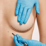 woman marked out cosmetic surgery 1.jpg